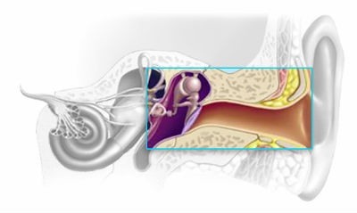 Hipoacusia conductiva