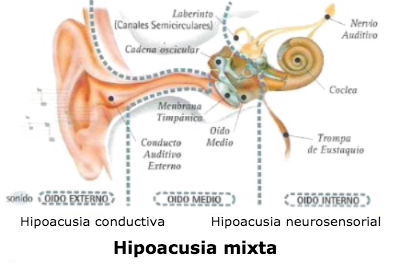 Hipoacusia mixta