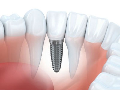 Implantes dentales ventajas