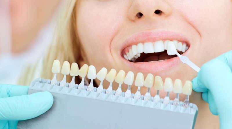 Las carillas dentales como solucion para tu dentadura